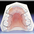 removable